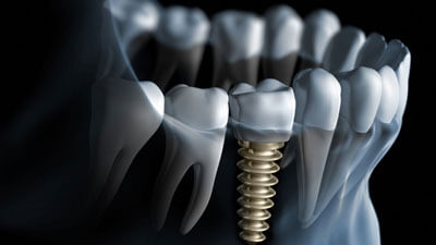 dental implant