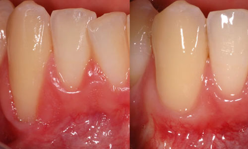 gum-treatment