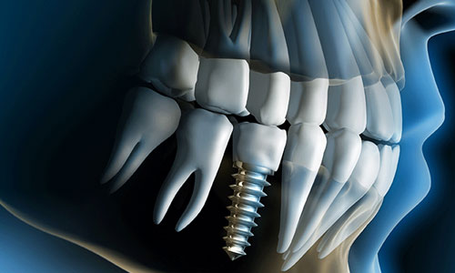 Benefits of Dental Implant